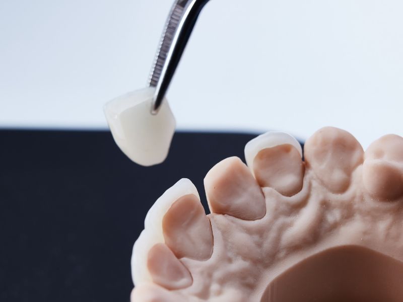 Hangi Protetik Tedavi Sizin İçin Uygundur - Dent Ekspres Eskişehir Çocuk Diş Hekimi