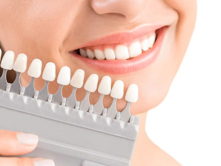 Porselen Veenerler - Dent Ekspres Eskişehir Çocuk Diş Hekimi